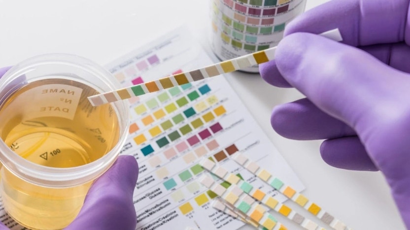 Urine color test chart showing hydration levels and health indicators