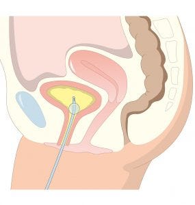 Woman with indwelling catheter 